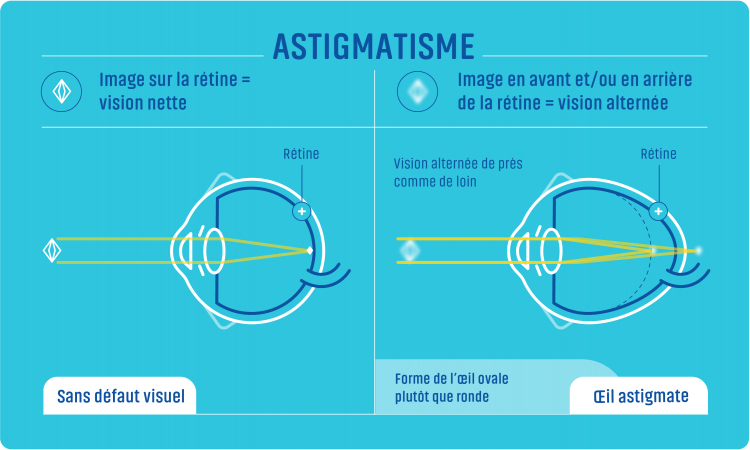 Schéma illustrant l'astigmatisme, défaut visuel caractérisé par une vision alternée de près comme de loin.